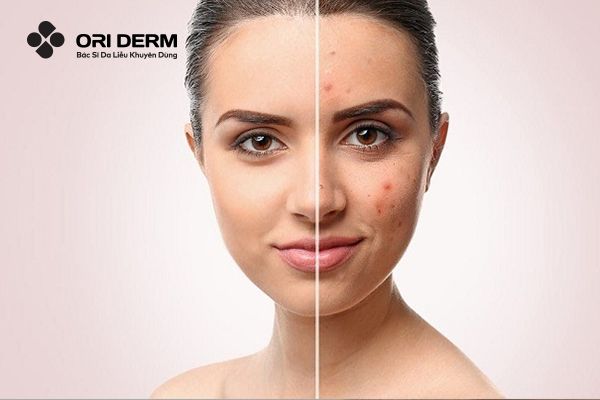 Tác dụng của thuốc trị sẹo thâm