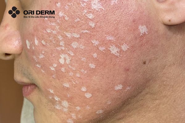 Chấm TCA - cách trị sẹo rỗ trên mặt