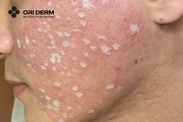 Chấm TCA điều trị sẹo đáy nhọn