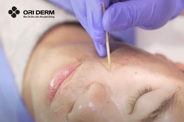 TCA CROSS (Chấm TCA)