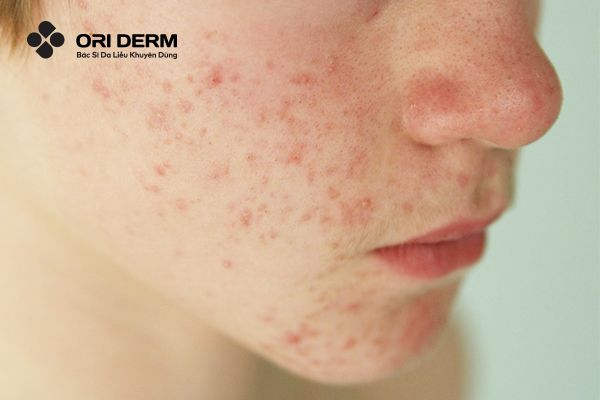 Thâm đỏ sau mụn là gì?