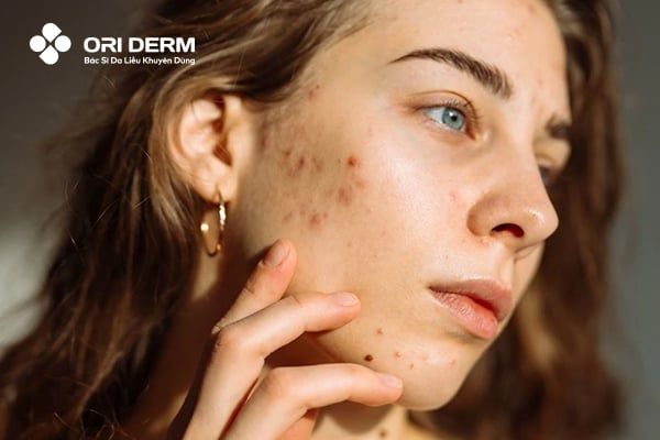 Thâm mụn là gì?