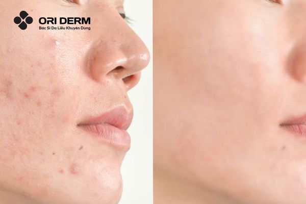 Thâm mụn bao lâu thì hết?