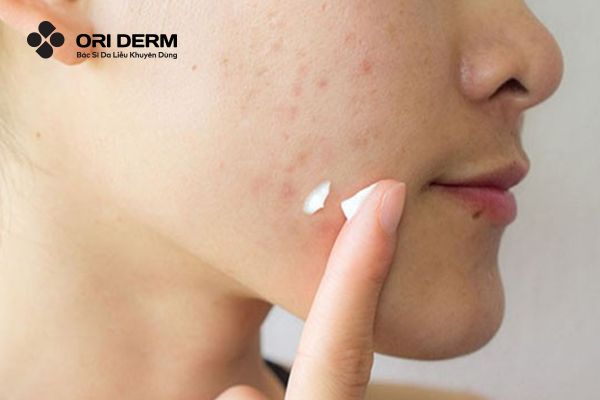 Thoa/chấm kem trị mụn