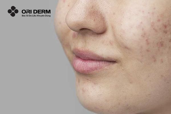 Nguyên nhân gây ra sẹo thâm