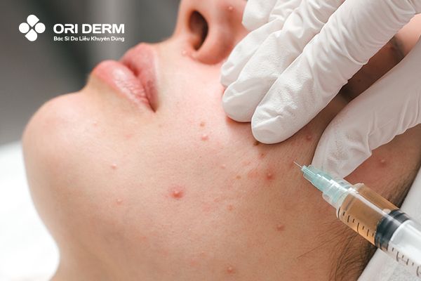 Tiêm Glucocorticoid trị mụn