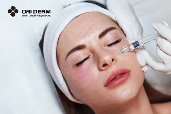 Tiêm meso (Mesotherapy)