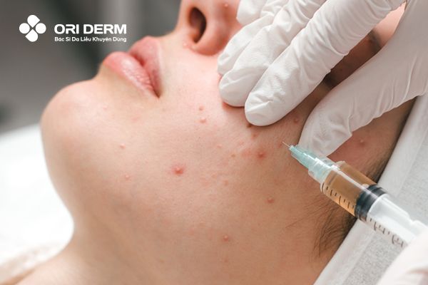 Tiêm meso trị mụn là gì?