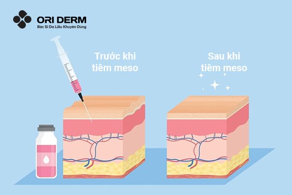 Tiêm meso làm đầy sẹo rỗ là gì?