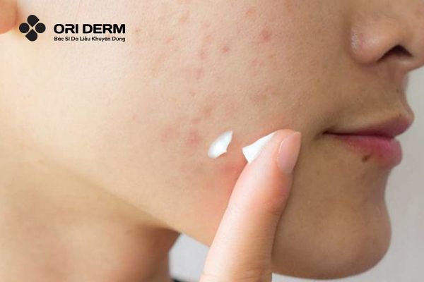 Tiêu chí lựa chọn thuốc trị sẹo thâm