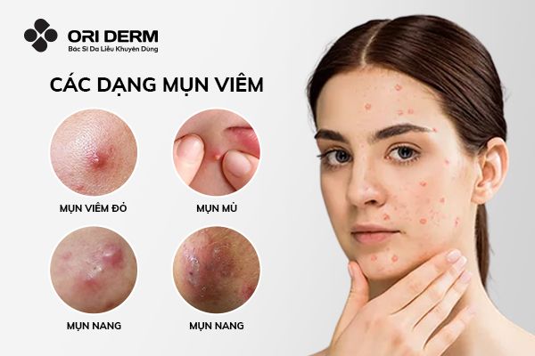 Tìm hiểu chung về mụn viêm