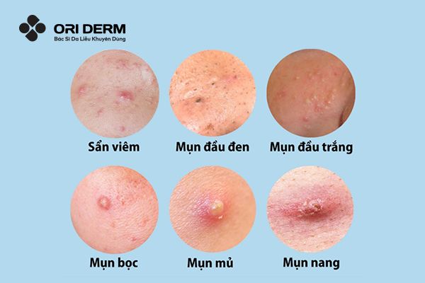Tìm hiểu chung về mụn