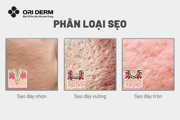 Tổng quan về sẹo rỗ