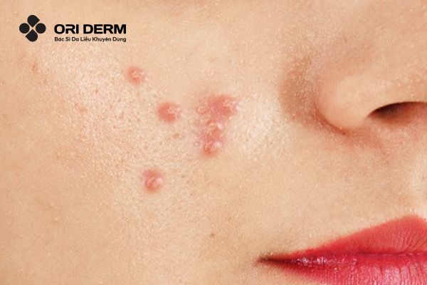 Tìm hiểu mụn viêm đỏ không nhân