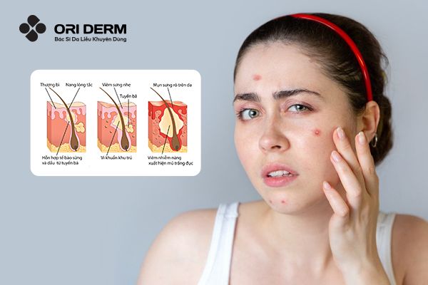 Tổng quan về mụn viêm