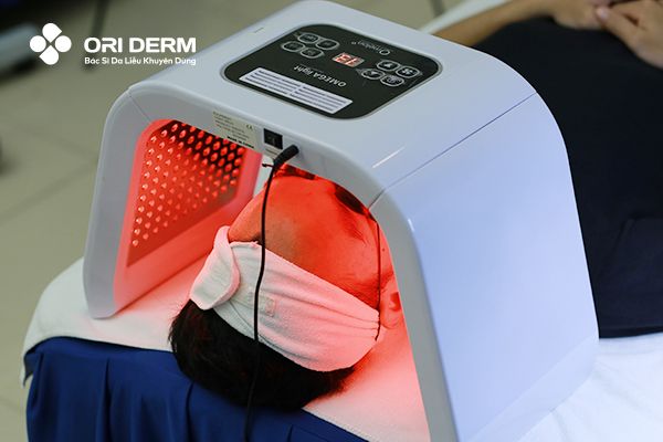 Trị mụn viêm mủ bằng công nghệ cao