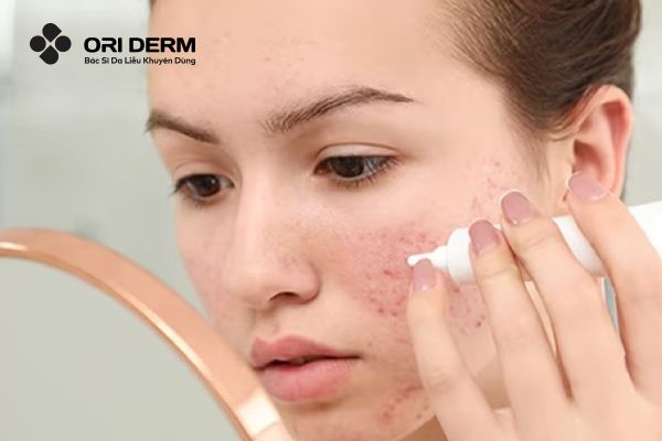 Điều trị mụn viêm mủ bằng thuốc bôi