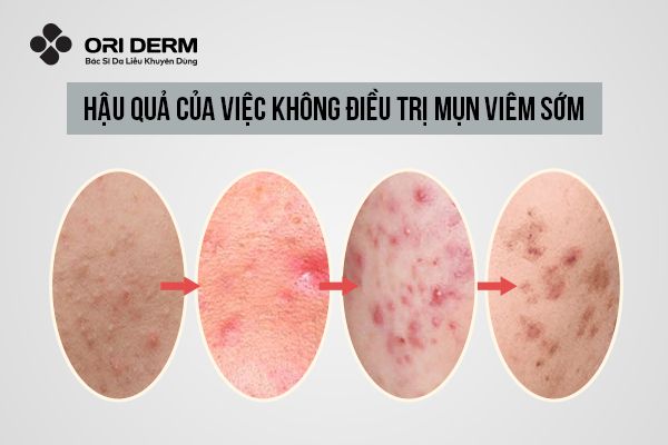 Vì sao nên điều trị mụn viêm ở trán càng sớm càng tốt?