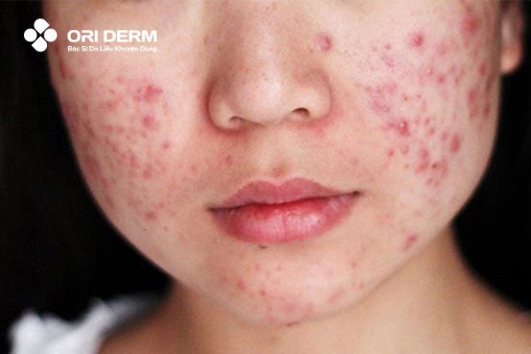 Trường hợp bị mụn trứng cá nặng