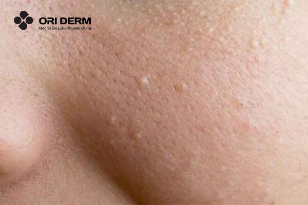 Mụn trứng cá nhẹ