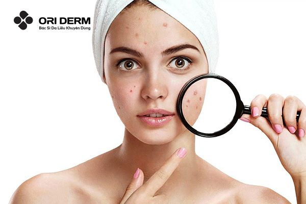 07 Loại Thuốc Uống Trị Mụn Nội Tiết Cho Nữ Mà Bạn Không Nên Bỏ Qua