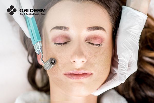 Lăn Kim Trị Sẹo Rỗ Có Tốt Không? Những Lưu Ý Cần Biết