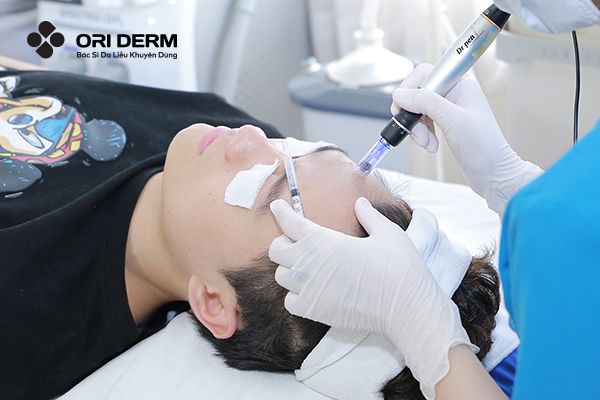 Lăn Kim Là Gì? Tác Dụng Của Lăn Kim Mặt Đối Với Làn Da