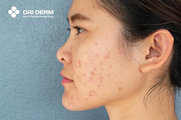 Ưu - Nhược điểm của phương pháp laser trị thâm mụn