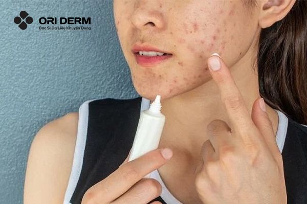 Sử dụng thuốc uống, thuốc bôi để gom cồi mụn