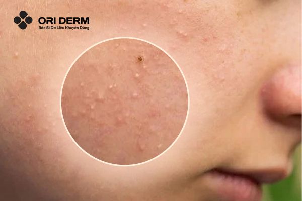 Mụn ẩn dưới da và những dấu hiệu để nhận biết