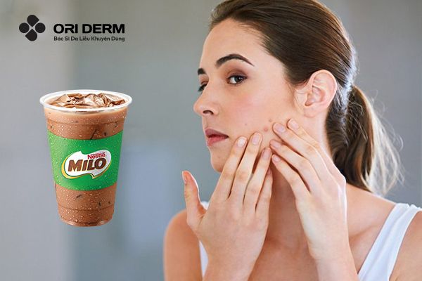 Uống milo có nổi mụn không? Vì sao?