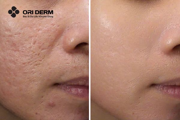 Ưu điểm tiêm meso trị sẹo rỗ