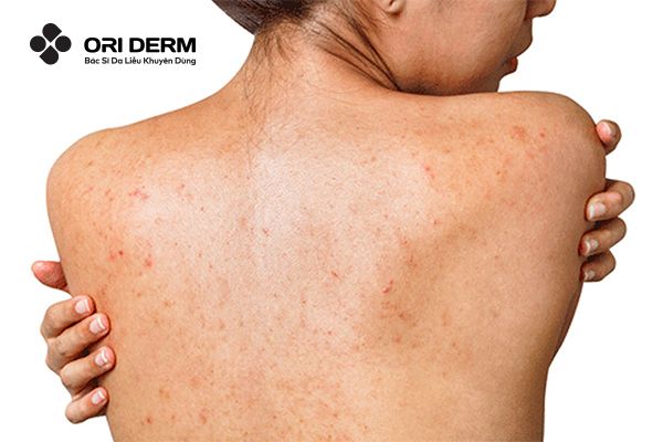 Những lưu ý khi dùng thuốc trị mụn lưng