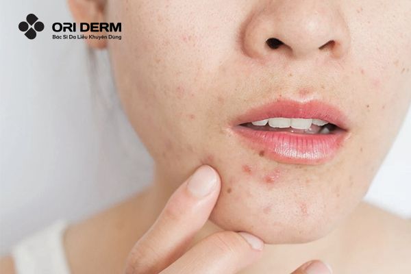 Nguyên nhân gây ra mụn viêm