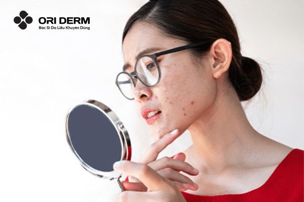 Đặc điểm, vị trí và quá trình phát triển của mụn ẩn