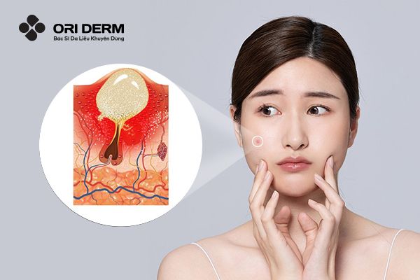 Mụn Viêm Dưới Da Là Gì? Phân Loại Và Cách Điều Trị Hiệu Quả