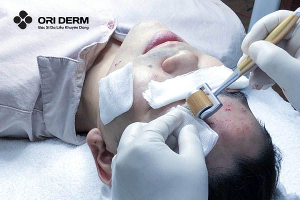 Các bước lăn kim trị sẹo rỗ chuẩn y khoa