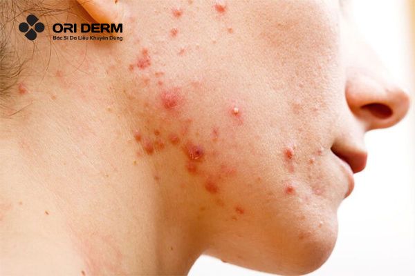 Vậy mụn viêm có tự hết không?