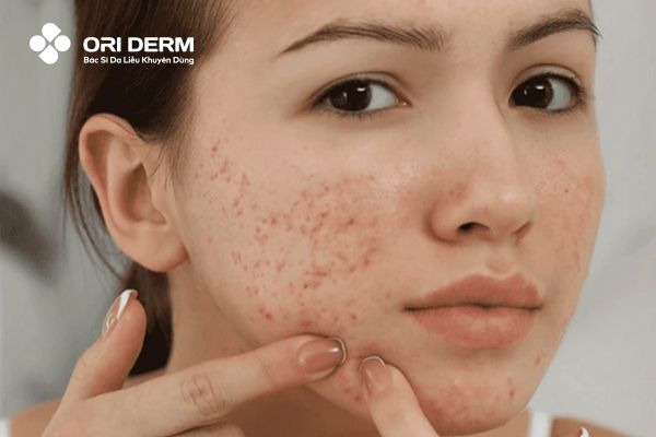 Vì sao nên gom cồi mụn nhanh chóng?