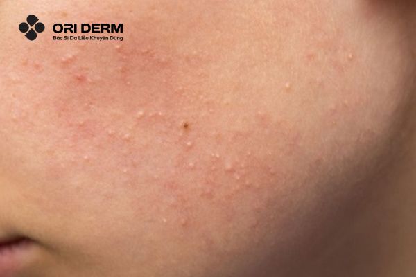 Vì sao da dầu dễ nổi mụn ẩn?