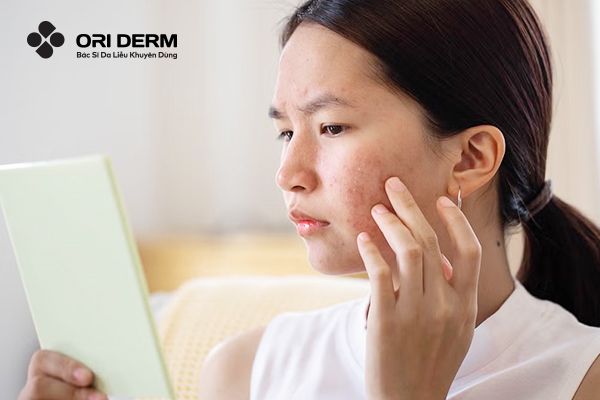 Vì sao dùng retinol bị lên mụn?