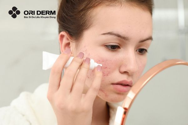 Vì sao nên sử dụng kem trị thâm mụn?