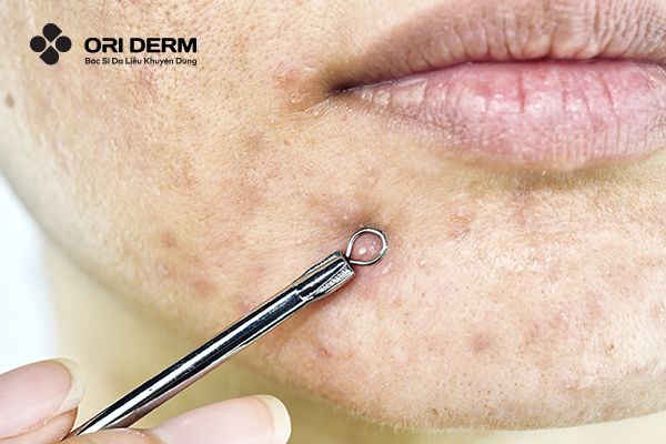 Vì sao vết thâm mụn mãi không hết?