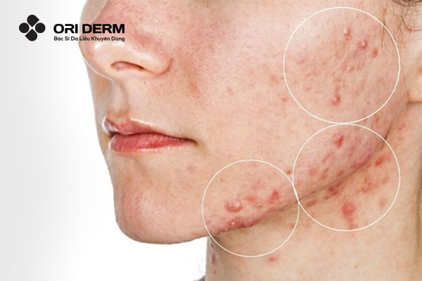 Vị trí thường gặp của mụn bọc