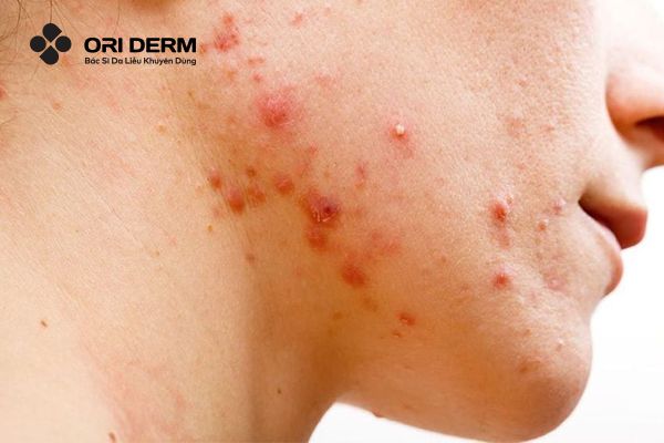 Viêm da mủ là gì?