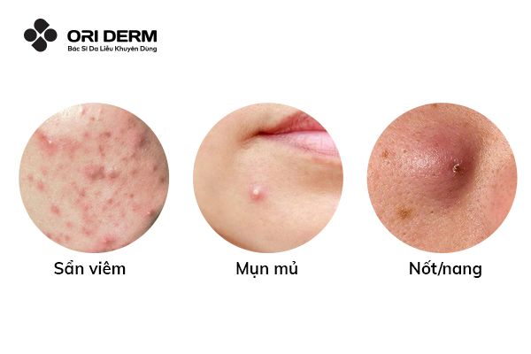 Mụn viêm là gì? Các dạng mụn viêm phổ biến