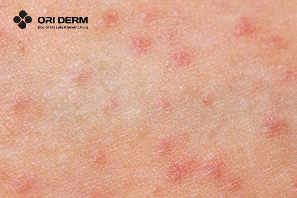 Viêm nang lông nông