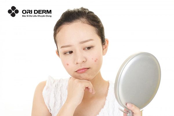 Khám Phá Nguyên Nhân Và Cách Trị Mụn Viêm Ở Má Hiệu Quả, Dứt Điểm