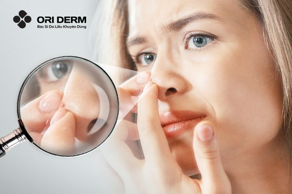 Mụn Viêm Ở Mũi: Đặc Điểm, Nguyên Nhân Và Cách Trị Hiệu Quả
