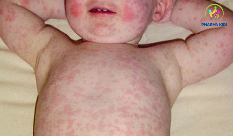 4 biến chứng nguy hiểm khi trẻ bị sốt phát ban